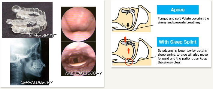 Sleep Apnea