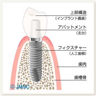 インプラントとはphoto