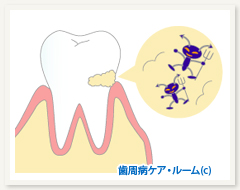 歯垢イメージ