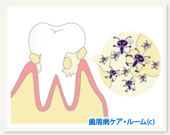 歯石イメージ